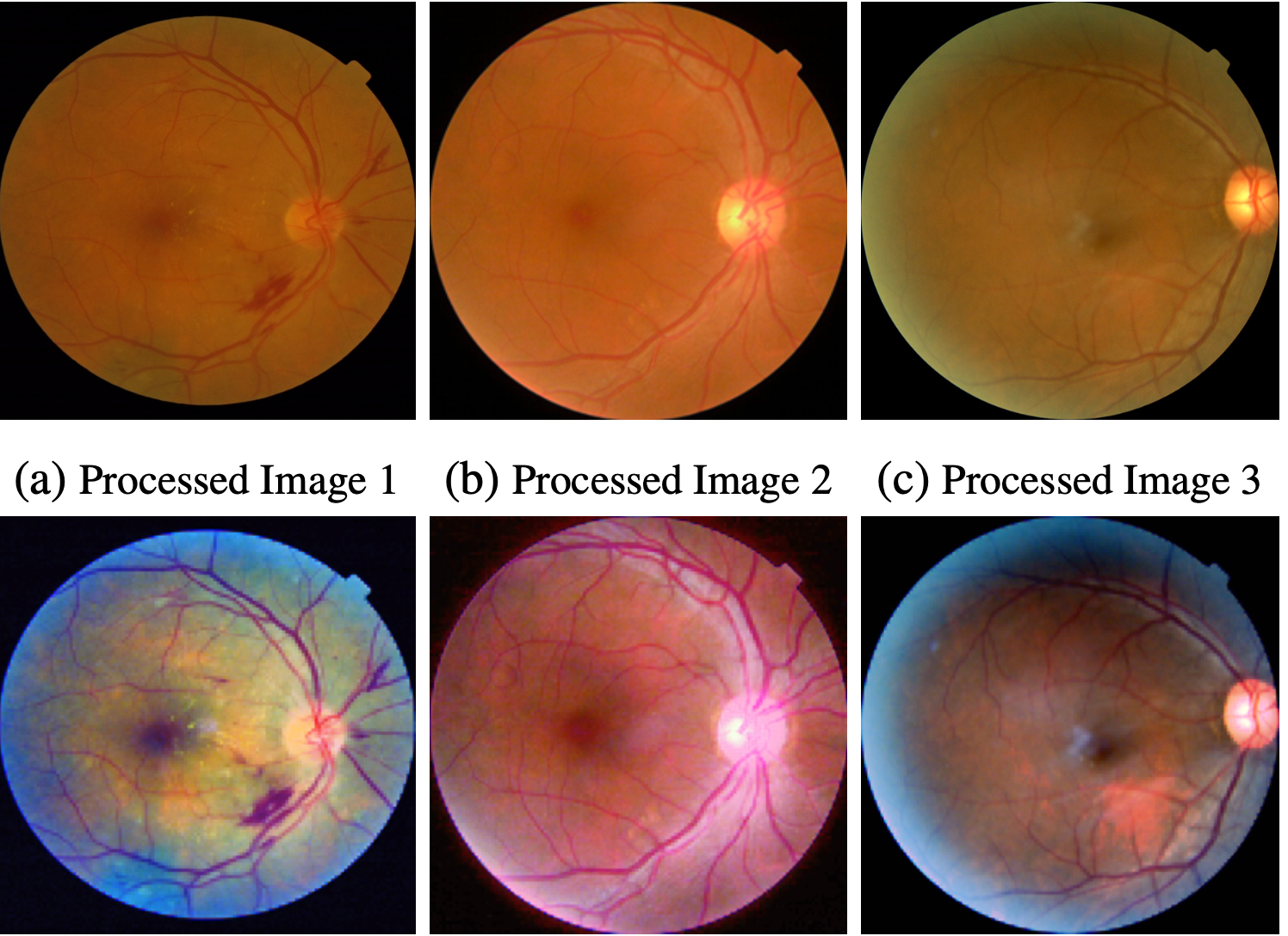 Unified technique for entropy enhancement based diabetic retinopathy detection