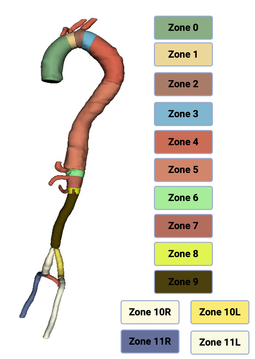 Volumetric analysis of acute uncomplicated type B aortic dissection