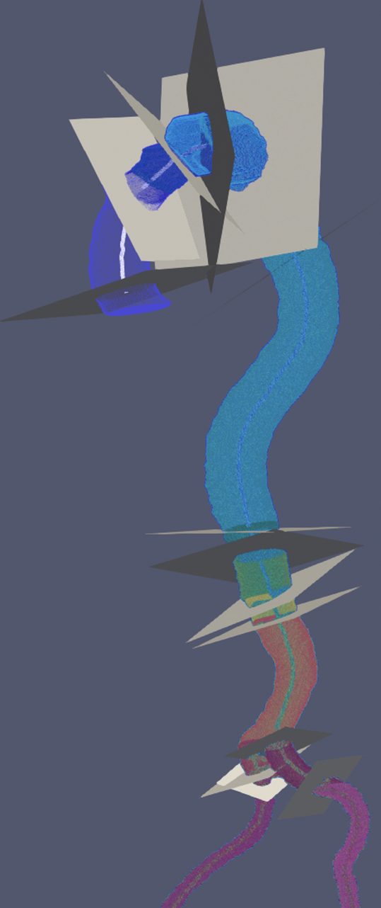 Comparison of Maximal Aortic Diameter Measurements