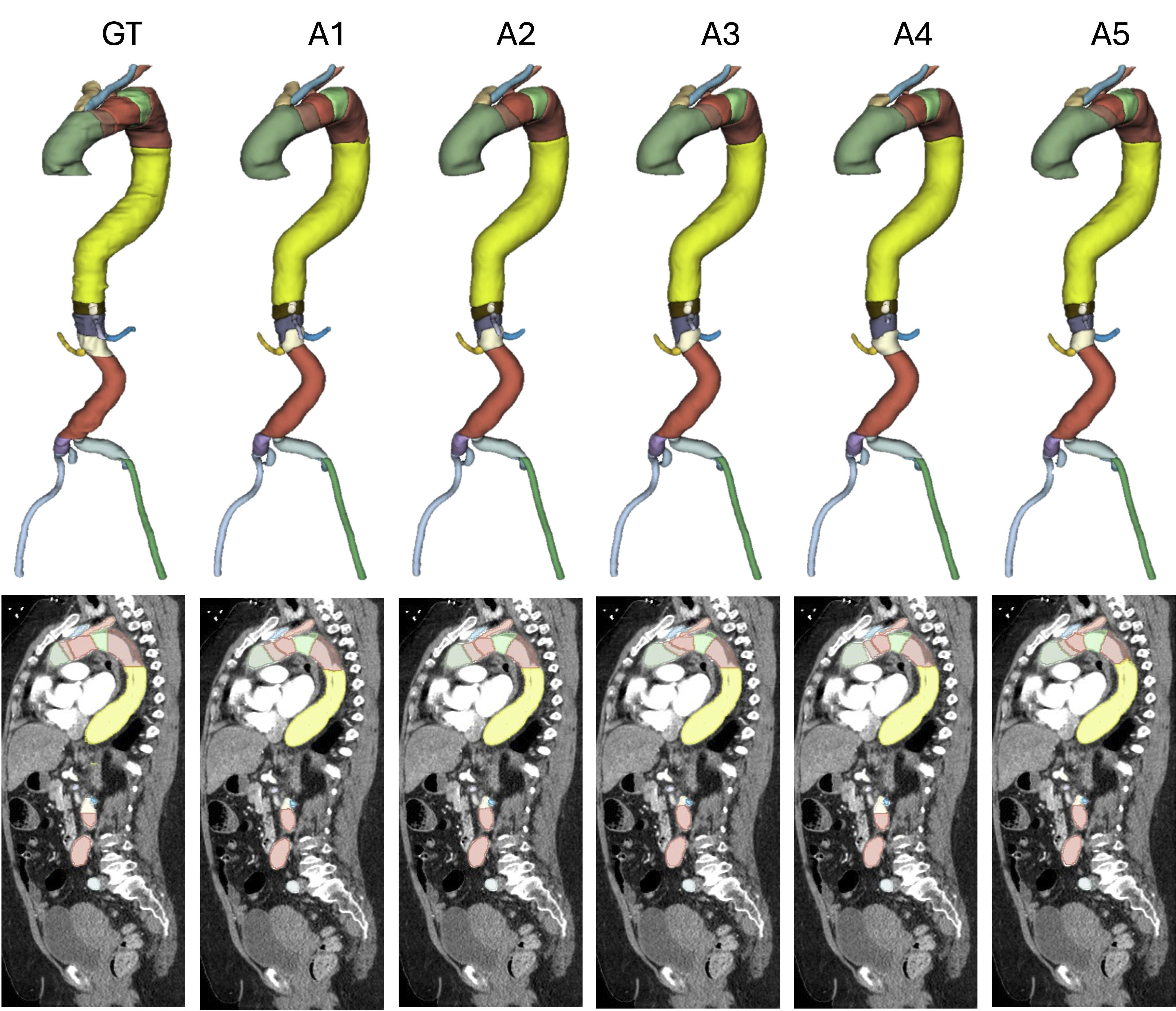 AortaSeg24 multi-class aortic segmentation